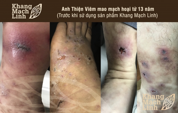 13 NĂM MẮC VIÊM MAO MẠCH HOẠI TỬ: THỨC TRẮNG ĐÊM VÌ ĐAU NHỨC