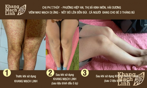 Mắc viêm mao mạch dị ứng sau sinh: Nỗi khổ của nhiều chị em