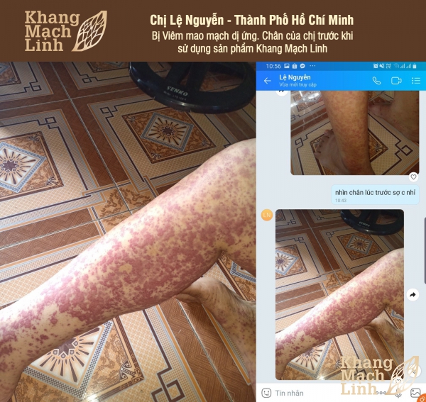 BÍ QUYẾT THOÁT KHỎI NHỮNG NỐT PHÁT BAN GHÊ SỢ CỦA CHỊ LỆ Ở TP HỒ CHÍ MINH