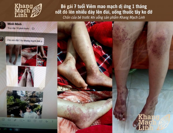 Mật bí mẹo cùng con vượt qua bệnh viêm mao mạch dị ứng dễ dàng nhất