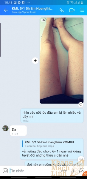 Ăn ngon ngủ kĩ vì không còn xuất huyết do viêm mao mạch dị ứng