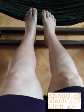 Xin đừng cắt cụt chi vì viêm tắc tĩnh mạch huyết khối