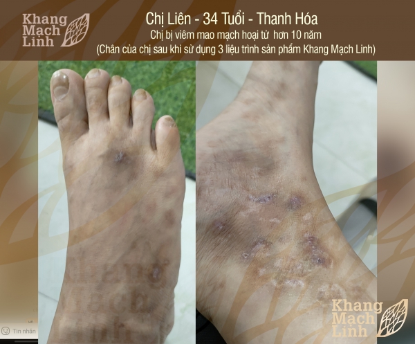 Tạm biệt 10 năm chống chọi với viêm mao mạch hoại tử
