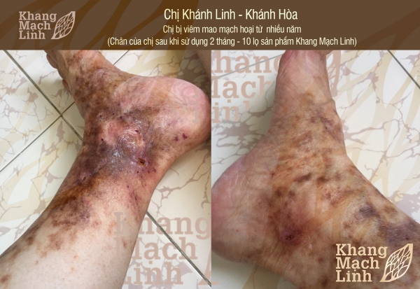 Đôi chân biến dạng, thâm tím vì viêm mao mạch hoại tử phải làm sao?