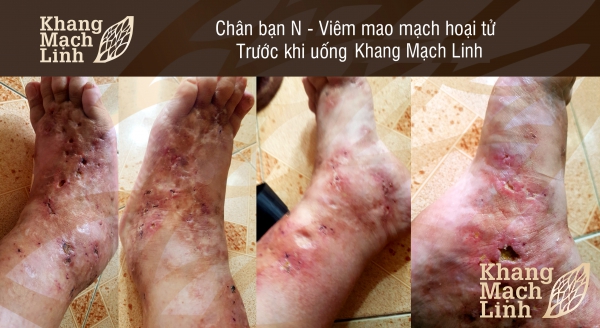 ĐỪNG ĐỂ VIÊM MAO MẠCH HOẠI TỬ ĂN MÒN ĐÔI CHÂN