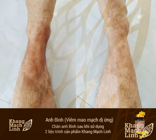 KHỐN KHỔ VÌ VIÊM MAO MẠCH DỊ ỨNG – KHÔNG CÒN LÀ NỖI LO
