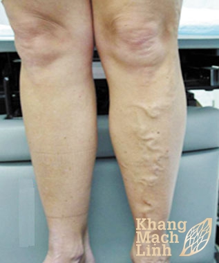 Thuốc uống trị suy giãn tĩnh mạch dùng đúng  cách theo ý kiến chuyên gia