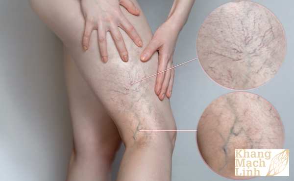 Giãn tĩnh mạch chân có chữa được không? Có cần mổ không?