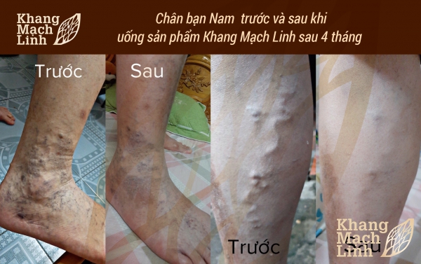DỨT ĐIỂM SUY GIÃN TĨNH MẠCH BẰNG THẢO DƯỢC TỰ NHIÊN