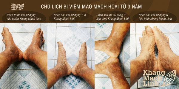 HÀNH TRÌNH VƯỢT QUA VIÊM MAO MẠCH HOẠI TỬ CỦA CHÚ LỊCH 70 TUỔI