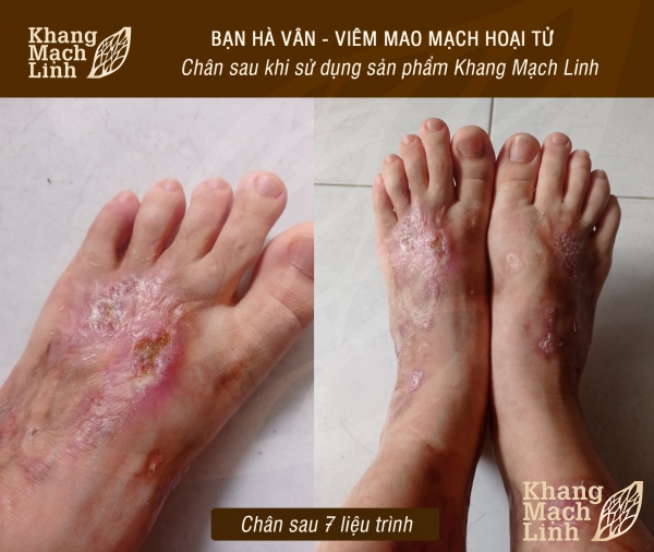 BÍ QUYẾT THOÁT KHỎI NỖI LO VIÊM MAO MẠCH HOẠI TỬ