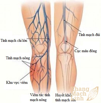 Viêm tắc tĩnh mạch nông chi dưới chẩn đoán và điều trị như thế nào?