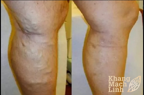 Huyết khối tĩnh mạch chân diễn biến âm thầm nhưng nguy hiểm
