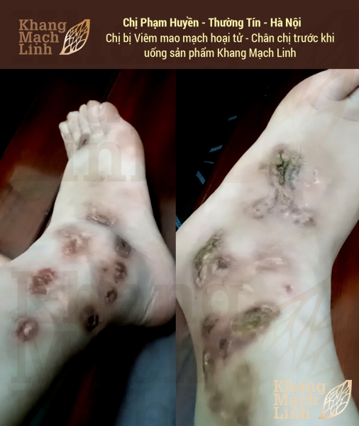 VIÊM MAO MẠCH HOẠI TỬ: KHÔNG CÒN LÀ NỖI LO