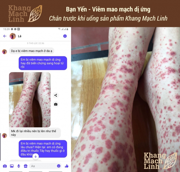 HOẢNG HỐT VÌ XUẤT HUYẾT MÀU ĐỎ DÀY ĐẶC HAI CHÂN
