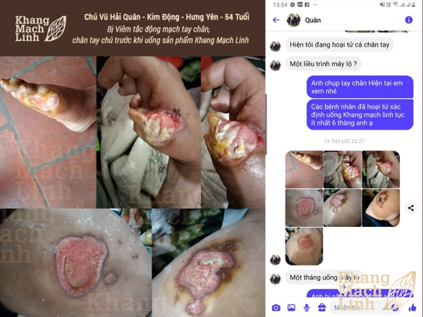 VIÊM TẮC ĐỘNG MẠCH: ĐỪNG CHỦ QUAN TRƯỚC BIẾN CHỨNG CẮT CỤT CHI