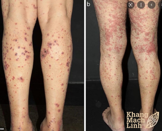 Schonlein Henoch là bệnh gì? Có thuốc điều trị không?