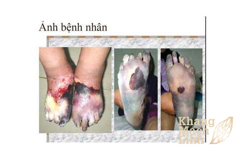 Dấu hiệu hoại tử chi và những điều cần biết để xử lý vết thương lan rộng