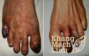 Bệnh hoại tử ngón chân: Nguyên nhân, biểu hiện, cách điều trị