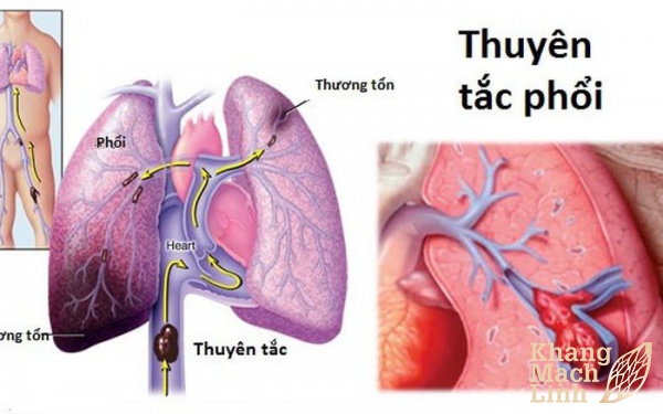 Tắc động mạch phổi gây tử vong đột ngột do phát hiện muộn