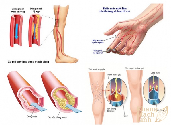 Viêm tắc động mạch chi dưới: Nguyên nhân, biểu hiện cách điều trị