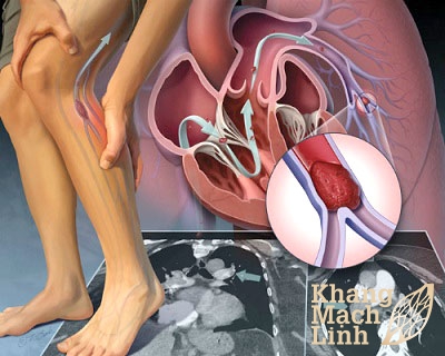 Viêm tắc động mạch: Chủ quan là chết
