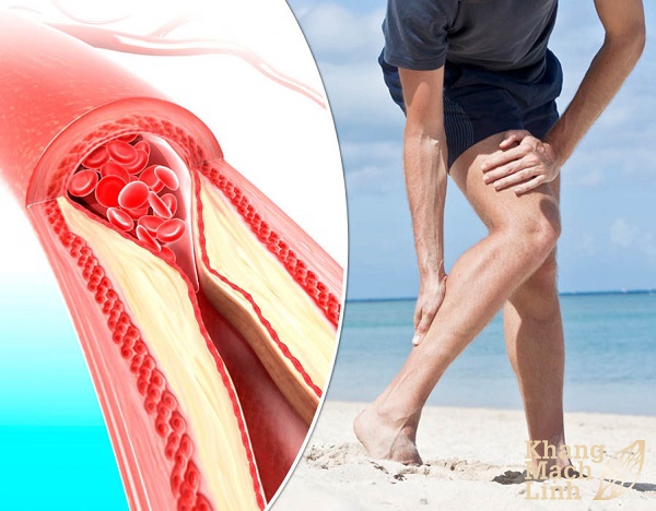 Tắc động mạch chi dưới: Phác đồ chẩn đoán và điều trị của chuyên khoa mạch máu