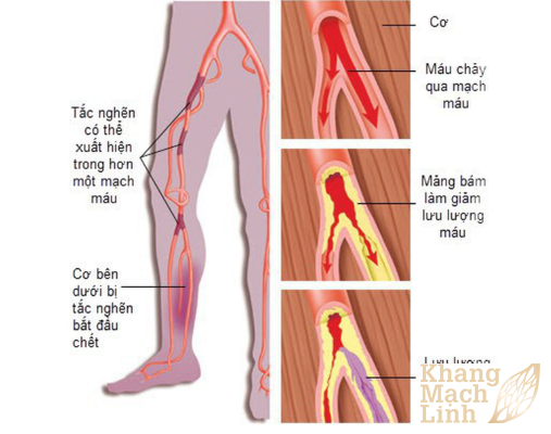 Tắc mạch máu chi dưới: Phát hiện sớm ngăn chặn biến chứng tàn phế