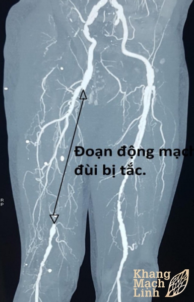Tắc động mạch chi có nên phẫu thuật không?