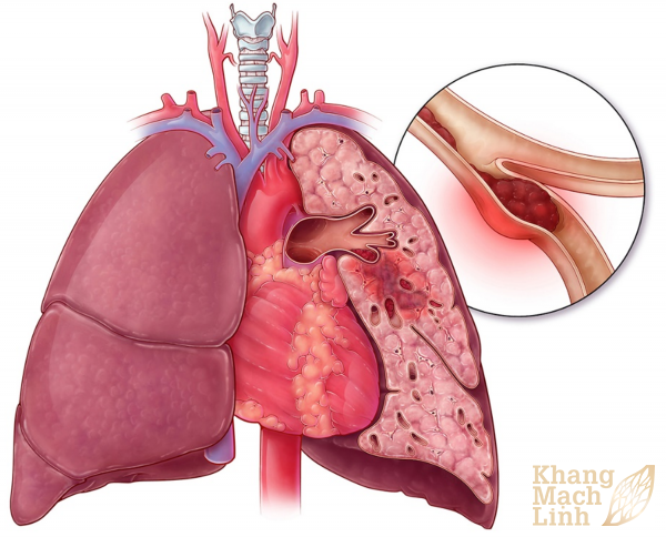 Tắc nghẽn động mạch phổi biến chứng nguy hiểm khó lường