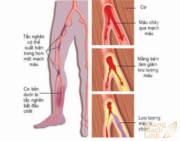 Triệu chứng tắc mạch chi dưới tránh nhầm lẫn với suy giãn tĩnh mạch