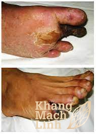 Viêm tắc động mạch chi: Báo động hoại tử chi
