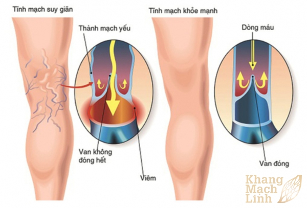 Suy van tĩnh mạch hai chi dưới và biện pháp điều trị mới nhất