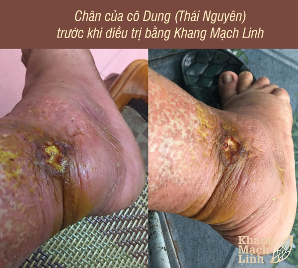 TÔI TƯỞNG CHẾT VÌ ĐAU ĐỚN, LỞ LOÉT CHÂN, CHẢY MÁU MỦ CẢ NĂM TRỜI