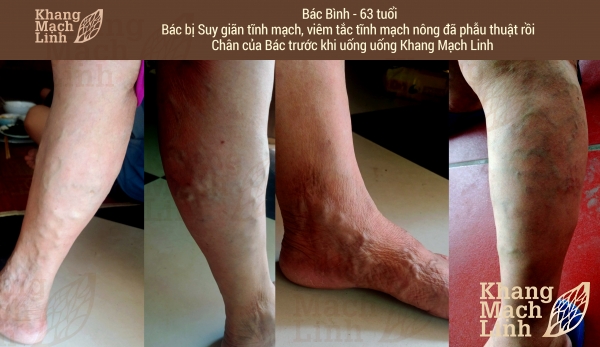 KHỐN KHỔ VÌ CHÂN SƯNG PHÙ, NỔI GÂN XANH, TÊ MỎI KÉO DÀI
