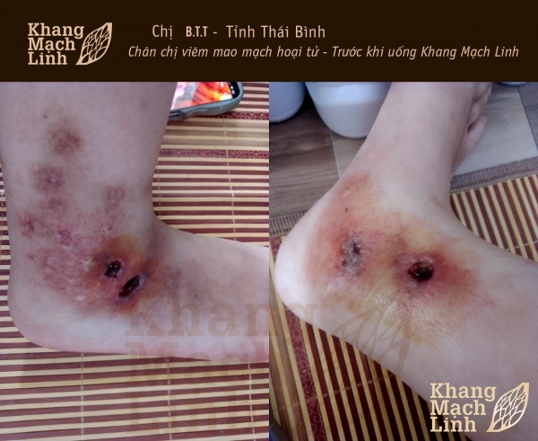 CHÂN NỔI NỐT THÂM ĐEN, LỞ LOÉT KHIẾN “TÔI ĐAU MUỐN CHẾT”