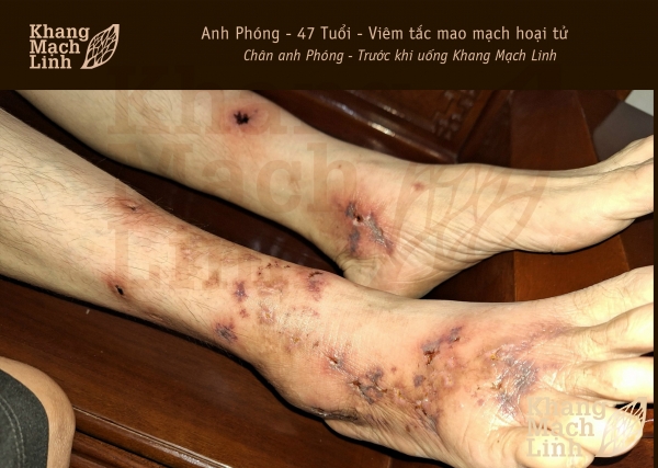 HỐT HOẢNG VÌ ĐÔI CHÂN THỦNG LỖ CHỖ DO VIÊM MAO MẠCH HOẠI TỬ