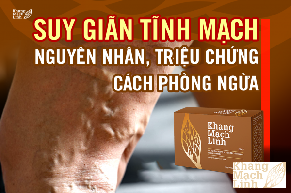 Suy giãn tĩnh mạch: Nguyên nhân, triệu chứng, cách phòng ngừa