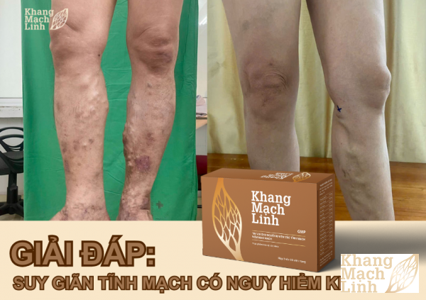 Giải đáp: Bệnh suy giãn tĩnh mạch có nguy hiểm không?