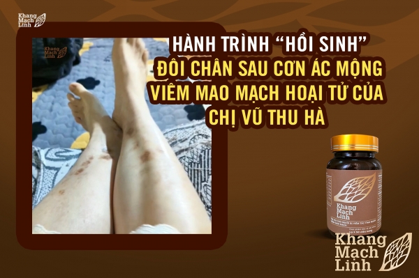 34 TUỔI VÀ HÀNH TRÌNH “HỒI SINH” ĐÔI CHÂN SAU NHỮNG CƠN ÁC MỘNG VIÊM MAO MẠCH HOẠI TỬ