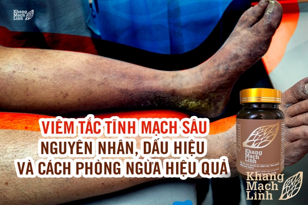 Viêm tắc tĩnh mạch sâu: Nguyên nhân, dấu hiệu và cách phòng ngừa hiệu quả