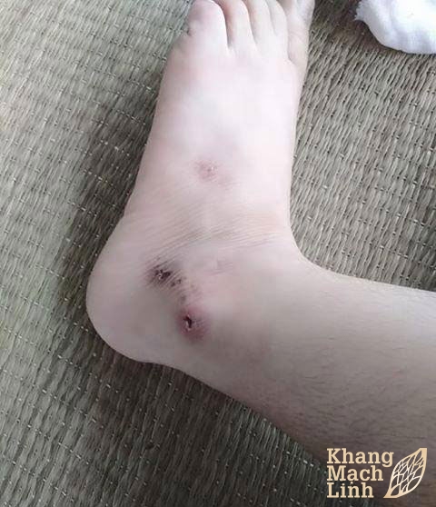 Hạnh phúc của cô gái trẻ bị viêm mao mạch dị ứng chuyên sang hoại tử