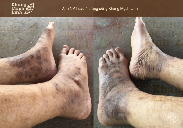 “Anh không tin chỉ mấy viên thảo dược này lại chữa lành được vết hoại tử ở chân của anh”