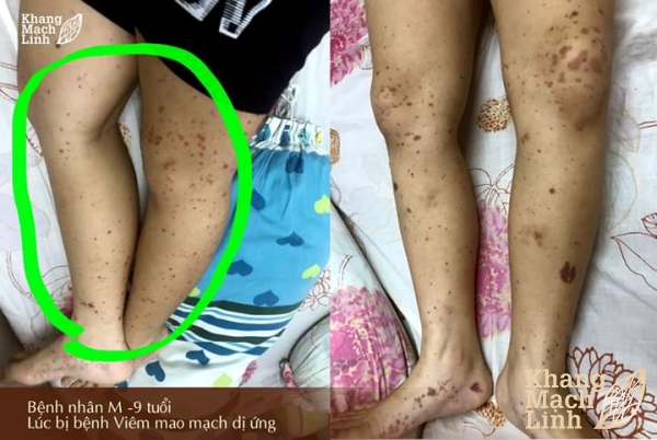 Viêm mao mạch dị ứng ở trẻ em – Không còn là nỗi lo