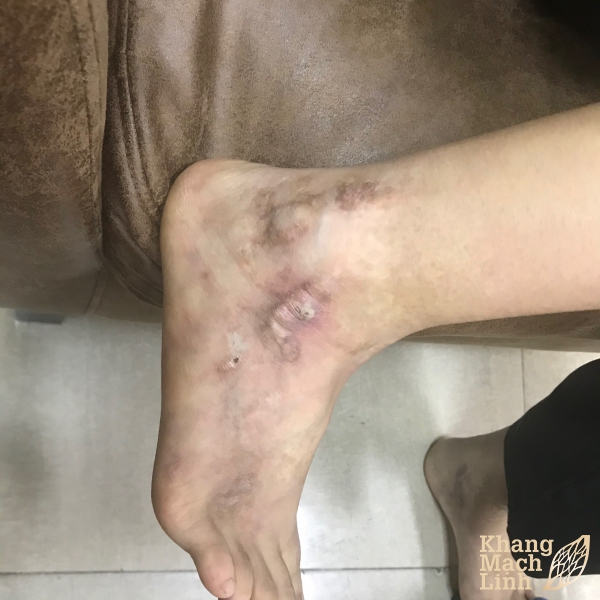 Hành trình 10 năm loại bỏ căn bệnh viêm mao mạch hoại tử