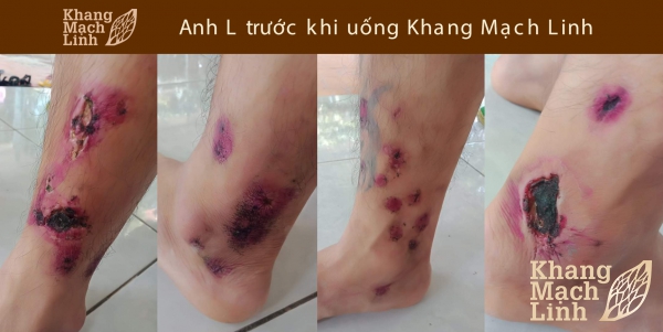 Đẩy lùi nỗi lo cắt cụt chi dưới vì viêm mao mạch hoại tử