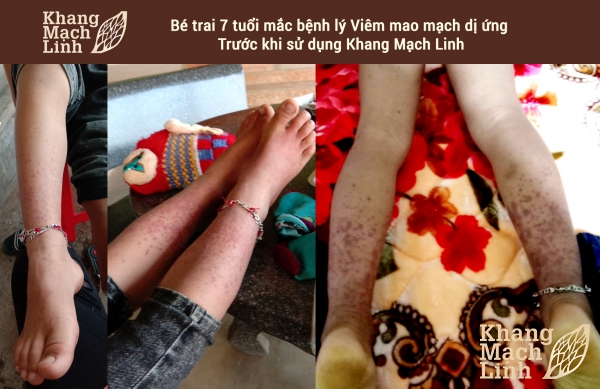 Trị viêm mao mạch dị ứng ở trẻ em: Cần đúng cách!