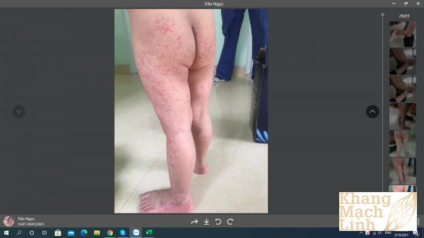 Nỗi lòng người mẹ giúp con vượt qua viêm mao mạch dị ứng