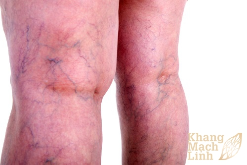 Giãn mao mạch có thể điều trị tận gốc không?