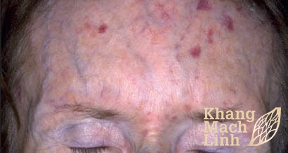 Bệnh giãn mao mạch xuất huyết di truyền có khỏi được không?